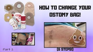 HOW TO CHANGE YOUR OSTOMY BAG Part 2 [upl. by Ardnoyek]