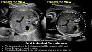 How To Measure Fetal Abdominal Circumference AC On Ultrasound  Fetal Biometry  Obstetric USG [upl. by Aziul]