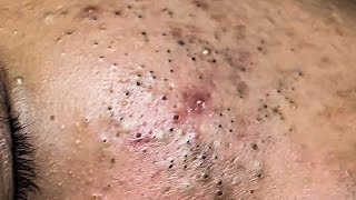 POPPING BLACKHEADS ON FACE NEWEST BLACKHEADS VIDEOS 2021 [upl. by Ellerahs]