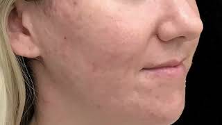 Nurse Lauren explains What Is Collagen Induction Microneedling [upl. by Gannie926]