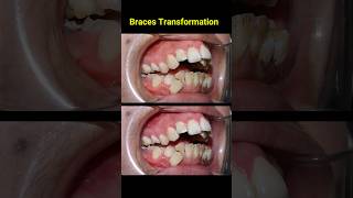 Braces Transformation 3 years braces dentist orthodontist niengrang nhakhoa [upl. by Vlada]