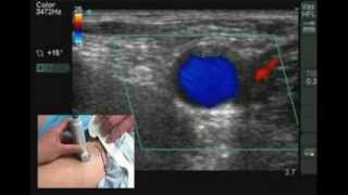 Ultrasound guided Nerve block and Cannulation  Tutorial [upl. by Yhcir]