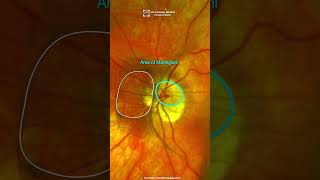 Posterior vitreous detachment amp Retinal detachment [upl. by Griffin]