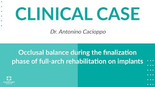 CLINICAL CASE Occlusal balance during the finalization phase of full arch rehabilitation on implants [upl. by Alehcim]