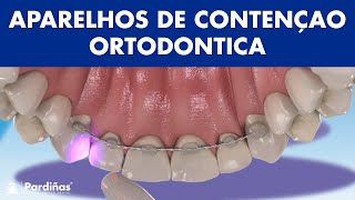 APARELHOS DE CONTENÇAO  Como evitar que os dentes se desloquem após a ortodontia © [upl. by Tavy]