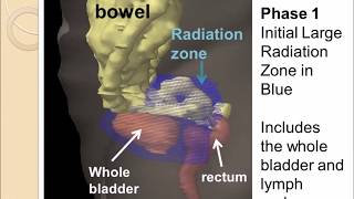 Radiation Therapy for Bladder Cancer [upl. by Selda]