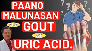 Paano Malunasan ang Gout at Uric Acid  By Doc Willie Ong [upl. by Yrovi]