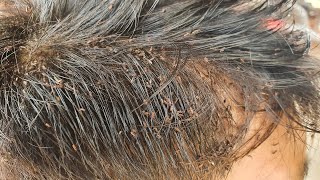 Chill video to watch head lice removal 42 [upl. by Oribella923]