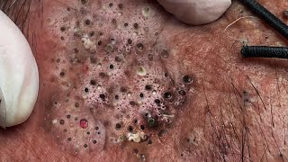 Big Cystic Acne Blackheads Extraction Blackheads amp Milia Whiteheads Removal Pimple Popping  2457 [upl. by Nuajed143]