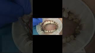 Multiple single piece dental implants healing tapping test after 6 months shorts [upl. by Nnaasil791]