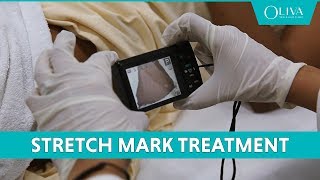 How To Remove Stretch Marks With Pixel Laser Resurfacing amp MNRF Treatments [upl. by Eiramanad117]