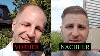 Haartransplantation vorher nachher 8 Monate [upl. by Tesil]