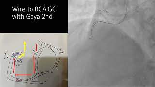 傑克老師CV manRCA CTO retrograde PCIPTCA [upl. by Mlehliw]