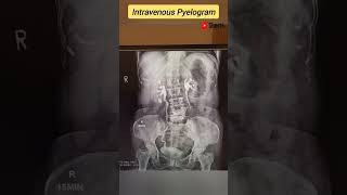 xray xraytechnician radiology procedure ivp intravenousinjection reels shortvideo trending [upl. by Adnohral644]