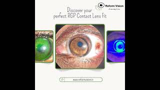 Keratoconus  RGP Contact lenses  Reform Vision  Hyderabad  Dr Reekham Lal [upl. by Annaeerb]