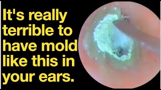 Its really terrible to have mold like this in your earsear wax removal  ear cleaning  ASMR [upl. by Naenej]