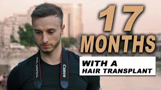 17 MONTHS AFTER HAIR TRANSPLANT [upl. by Intruoc774]