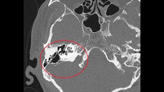 HRCT Temporal bone  A more detailed version  Basic to Advanced  AXIAL amp CORONAL VERSION 2 [upl. by Elrod]