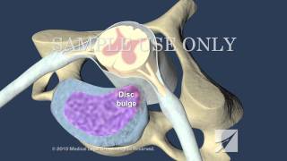 Cervical Disc Herniation [upl. by Kellsie352]