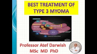 Best treatment of type 3 myoma [upl. by Uthrop716]