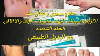 كريم فعال لعلاج فطريات الجلد والأظافر، كزيما، صيبانة، الحكة والبهك ميكوستر Mycoster 1 مع بديل طبيعي [upl. by Eicram]