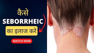 Seborrheic Dermatitis का इलाज  How To Treat Seborrheic Dermatitis कैसे seborrheic का इलाज करे [upl. by Notkcorb]