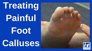 How to Treat Painful Foot Calluses [upl. by Dnomad589]