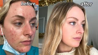 MY ACCUTANE JOURNEY  my acne experience QampA tips  pictures [upl. by Mellette]