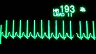 Supraventricular Tachycardia [upl. by Daffy]