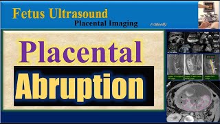 Fetus Ultrasound  Placental Abruption [upl. by Assertal]