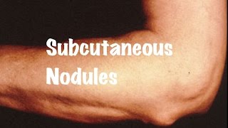 Brief information on Subcutaneous Nodules [upl. by Ecinue534]