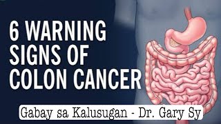 6 Warning Signs of Colon Cancer  Dr Gary Sy [upl. by Shaer]