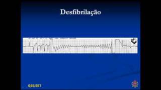 Desfibrilação 2 [upl. by Bink]