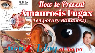 How to prevent Amaurosis Fugax or Temporary Blindness [upl. by Hertberg]