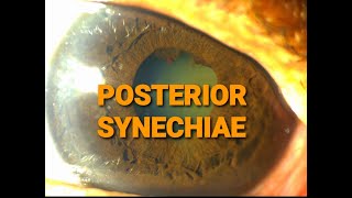 Ep 5 POSTERIOR SYNECHIAECLINICAL DISCUSSION ON SLIT LAMP [upl. by Drain]