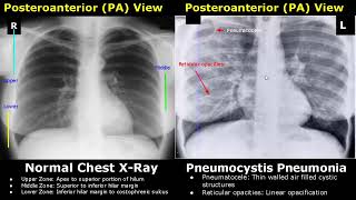 Chest XRay Lung Normal Vs Abnormal Image Appearances Part 1  TBPneumoniaConsolidationCollapse [upl. by Toh]