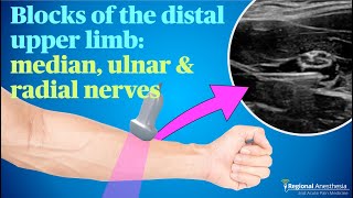 Ultrasound guided blocks of the median ulnar and radial nerves [upl. by Ane]