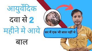 Dr Bansal Reveals Secret To Healthy Hair Alopeica Alopecia Universalis And Totalis [upl. by Eisej887]