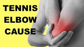 Tennis Elbow Causes amp Test Lateral Epicondylitis [upl. by Aziza]