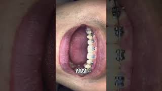 Tipos de Ligadura en Ortodoncia Brackets Ortodoncia Dentista [upl. by Forcier]