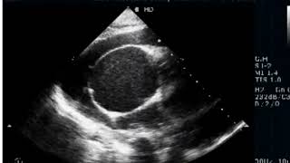 Severe Pulmonic Stenosis  RV non Compaction [upl. by Enrahs]