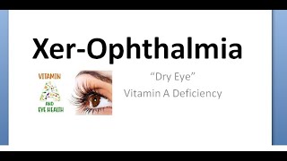 Ophthalmology 475 Xerophthalmia Vitamin A deficiency Eye Night blindness Ocular Classify Pediatrics [upl. by Shererd]