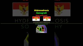 Sonografi  Hidronefrosis [upl. by Espy]