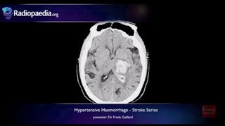 Stroke Hypertensive haemorrhage  radiology video tutorial MRI CT [upl. by Viglione911]