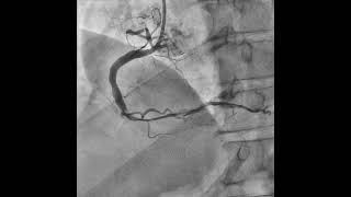 Large Thrombus Burden in a Large RCA [upl. by Amye]