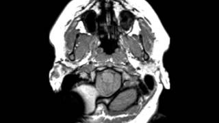 Chiari II Malformation [upl. by Reinert]