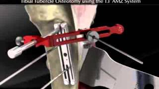 Tibial Tubercle Osteotomy using the T3 AMZ System [upl. by Sheeb]