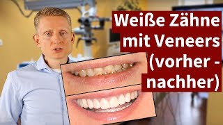 Weiße Zähne mit Veneers vorher  nachher 2021 [upl. by Maillw896]