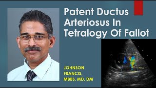 Patent Ductus Arteriosus In Tetralogy Of Fallot [upl. by Ailel]