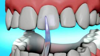 Dental Bonding Video  Tooth Bonding [upl. by Ahseyt]